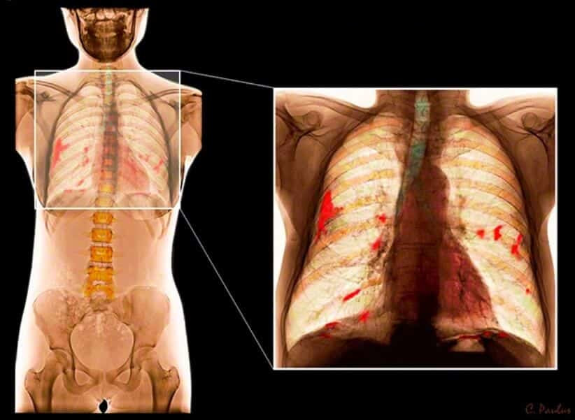 PULMONES AFECTADOS POR EL ASBESTO